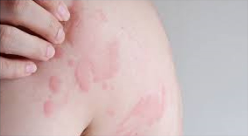 Urticaria, commonly known as hives; Common triggers for urticaria include