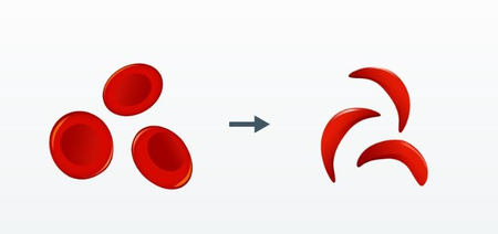 Sickle Cell Disease: India achieves milestone with 6 cr screenings, says Govt