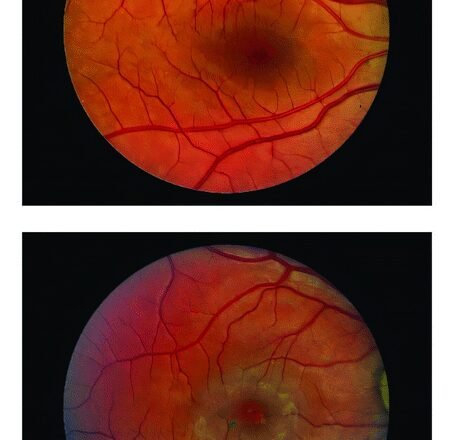 Surgical implant can slow down vision loss caused by blinding eye disease: Study