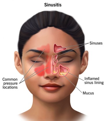 Surgery more effective in treating chronic sinus than antibiotics: Study