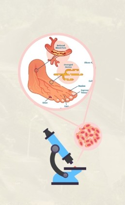 Nagaland University researchers find plant compound to treat diabetic wound, foot ulcers